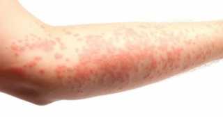 Появляться красные точки на теле как родинки: причины и советы