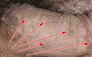 Остроконечные кондиломы у женщин и мужчин: причины и лечение