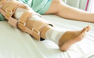 Перелом ноги