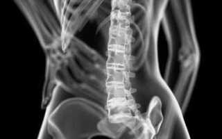 Артрит позвоночника