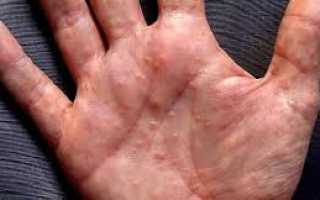 Водянистые пузырьки на руках и кистях: причины и лечение