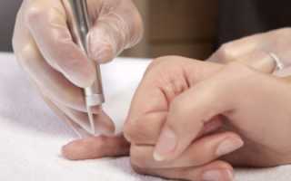 Нарост под ногтем на руке и ногах: причины и лечение