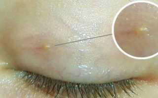 Милиумы на лице — причины и как избавиться от них эффективно?