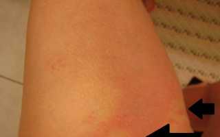 Воспаление лимфоузлов в паху — все этиология и причины