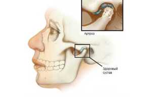 Как лечить артроз челюстного сустава?