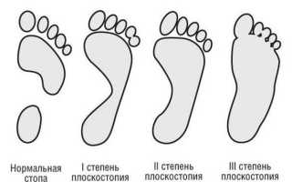 Как вылечить плоскостопие?