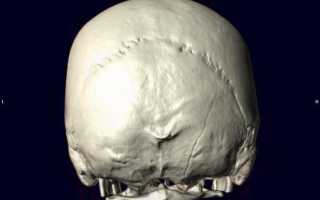 Перелом затылочной кости