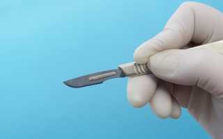 Операция по удалению фимоза