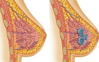 Инвазивная карцинома молочной железы