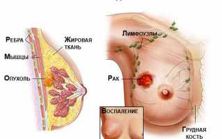 Инфильтрирующая карцинома неспецифического типа
