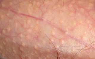 Почему появляются белые прыщики на члене? Причины и советы