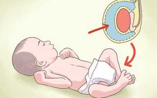 Водянка яичек у новорожденных: причины и лечение