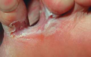 Слезает кожа между пальцами ног: причины и лечение