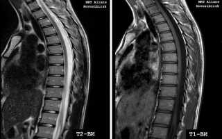 МРТ грудного отдела позвоночника