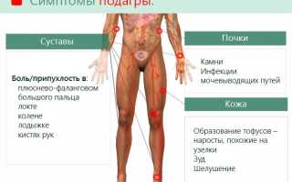 Симптомы и лечение подагры