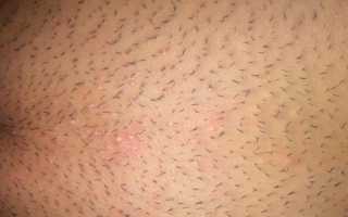 Раздражение от бритья в интимной зоне: причины и решения