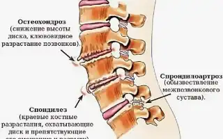 Артроз дугоотросчатых суставов