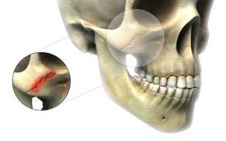 Перелом скуловой кости