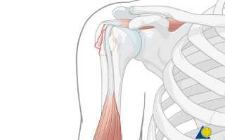 Перелом большого бугорка плечевой кости