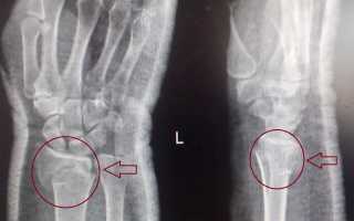 Перелом лучевой кости в типичном месте
