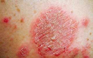 Почему появляются шершавые пятна на теле? Узнайте причины и методы лечения