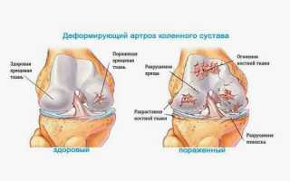 Деформирующий артроз коленного сустава