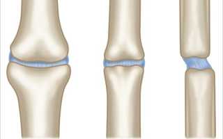 Ложный сустав после перелома