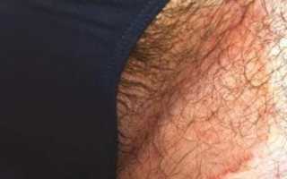 Почему появляются красные пятна в паху у женщин и мужчин? Узнайте причины и лечение