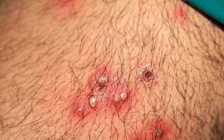 Пятна на внутренней стороне бедра: причины и лечение