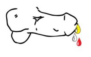 Выделения из головки у мужчин: причины и лечение