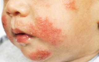 Сыпь у рта ребенка: причины и лечение