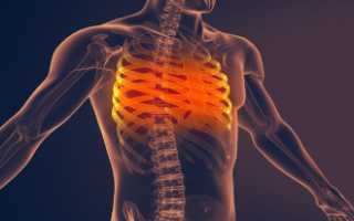 Перелом грудины и грудной клетки