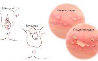 Паховый дерматит: причины и лечение