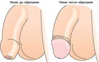 Короткая уздечка крайней плоти: причины и лечение