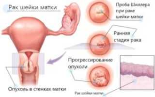 Как определяют рак шейки матки