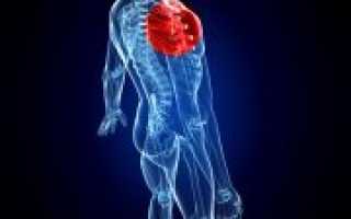 Первая помощь при вывихе