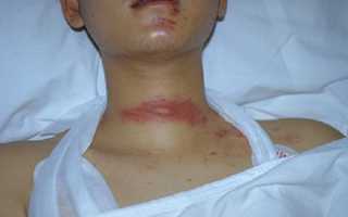 Перелом подъязычной кости