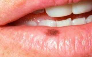 Пигментные пятна на губах — виды, причины и как их лечить