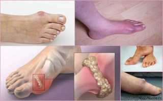 Артрит стопы