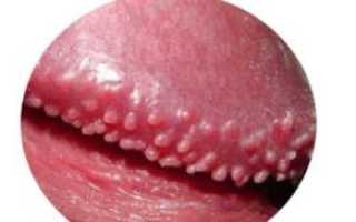 Гранулы Фордайса у мужчин и даже у женщин: причины и лечение