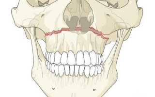 Перелом верхней челюсти