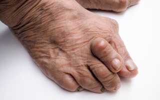 Артрит пальцев ног