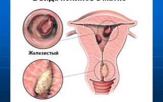 Дисгормональная гиперплазия эндометрия