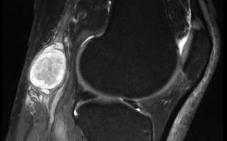 Что такое киста Бейкера коленного сустава? Лечение и оперативное вмешательство