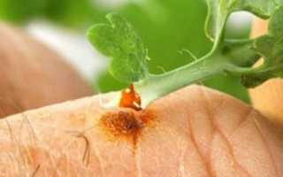 Как использовать чистотел от папиллом для здоровья кожи