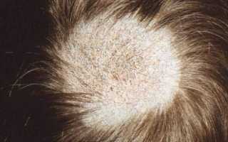 Белые пятна на голове — какая этиология и возможные причины?