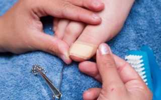 Появился синяк под ногтем — что делать в такой ситуации?