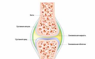 Реактивный артрит