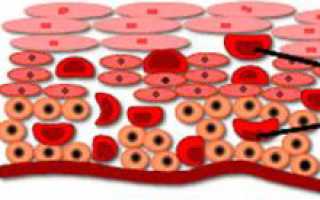 Дистрофия шейки матки