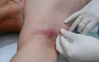 Чирей под мышкой: причины и лечение